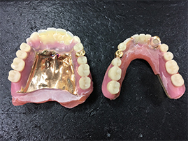 K14 金属床義歯 金歯 画像